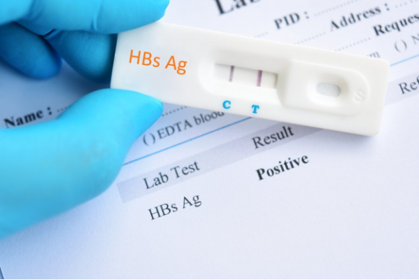 Tes Antigen Permukaan Hepatitis B yang Perlu Anda Ketahui 2 |