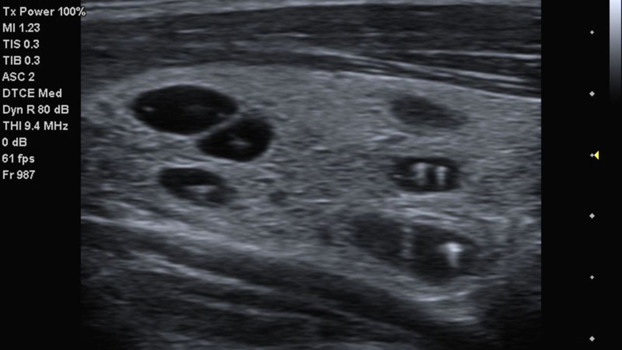 acuson-p500-thyroid-cysts-with-calcifications-02013828_10-06588477_10 |