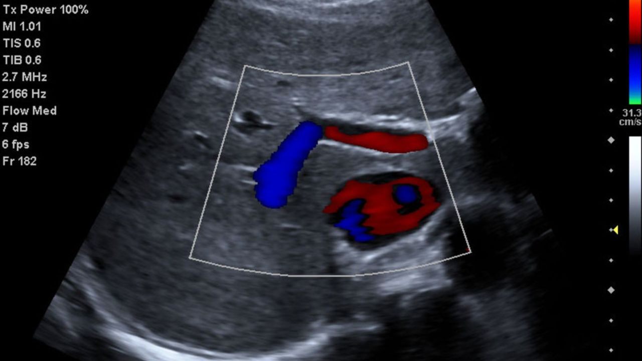 acuson-p500-transverse-liver-portal-veins-02013826_10-06588553_10-1 |