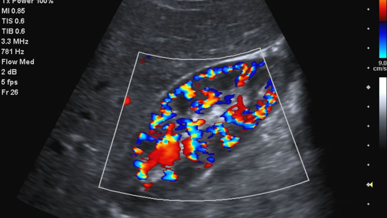 acuson_p500-color-doppler-right-kidney-02013831_10-06588534_10 |
