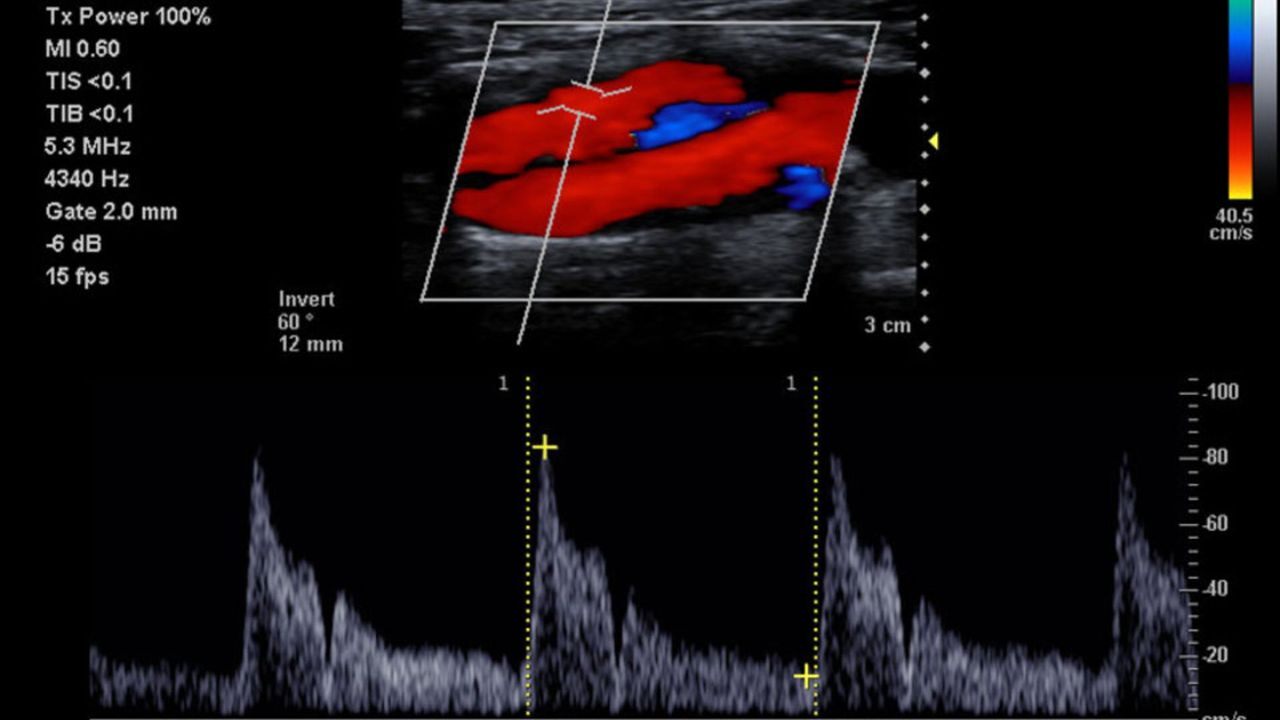 acuson_p500_carotid-bifurcation-02013822_10-06588542_10 |