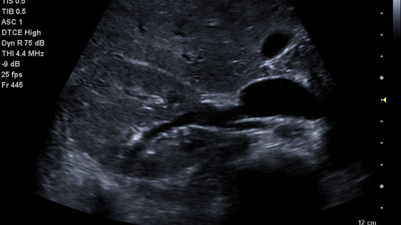 acuson_p500_transverse_kidney_liver-02013821_10-06588539_10 |