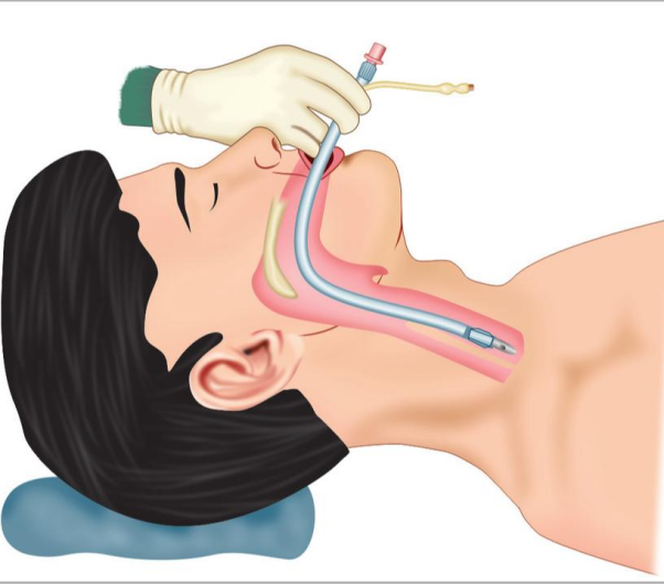 Tabung Endotrakeal dan Kegunaannya 1 |