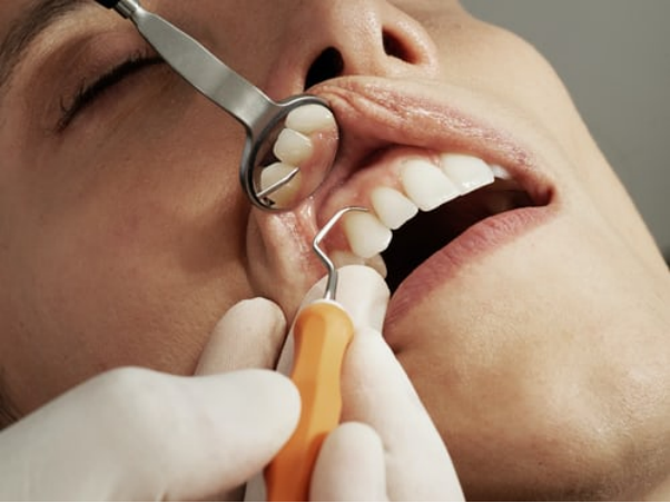 Jenis Bur Gigi & Kelebihannya untuk Pemeriksaan Dental 1 |