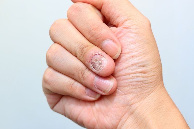 MENGENAL LEBIH DEKAT PENYAKIT JAMUR KUKU