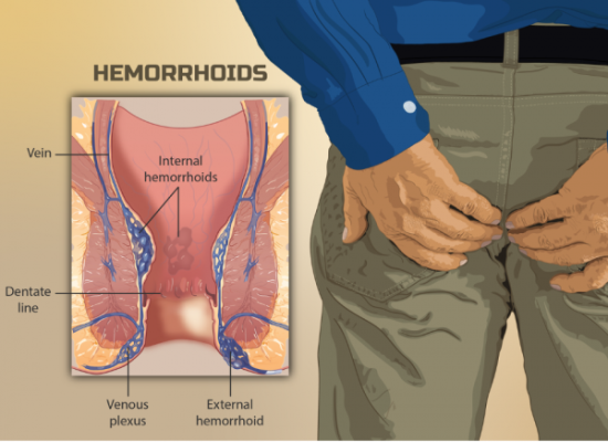 PAHAMI BERBAGAI GEJALA PENYAKIT HEMORRHOIDS