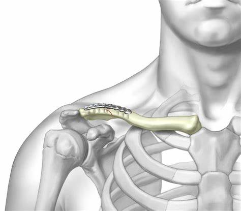 KETAHUI FITUR CLAVICLE S PLATE - 5, 6, 7, 8, 9, 10 HOLES LEFT