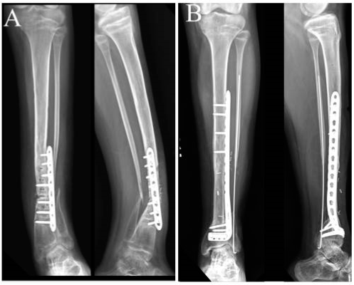 BONE PLATE - DISTAL TIBIA PLATE - 9, 10, 11 HOLES RIGHT