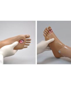 GAUMARD Kaki yang mengalami ulserasi