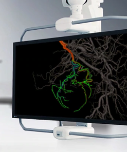 GE Embo ASSIST Virtual Injection: Visualisasi 3D Embolisasi