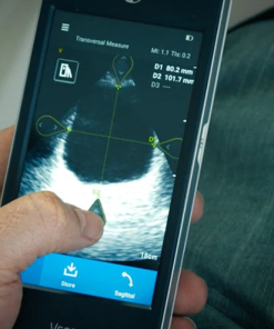 GE Vscan Extend™ Bladder Volume App