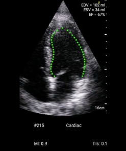 GE Vscan Extend™ LVivo EF