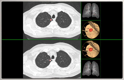 Lung VCAR Hero |