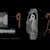 GE TAVI Analysis 2 |