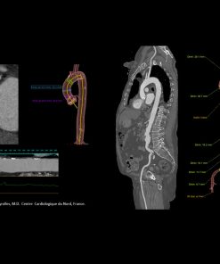 GE TAVI Analysis