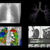 GE Thoracic VCAR 2 |