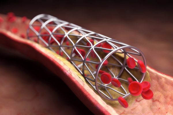 Simulator Pemasangan Stent Jantung