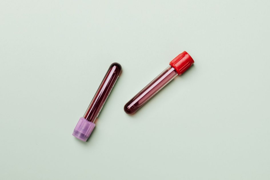 Golongan Darah O Disebut Lebih Rentan Kolesterol: 7 Fakta Penting 1 Blood samples in test tubes on a light background, ideal for medical and laboratory themes.