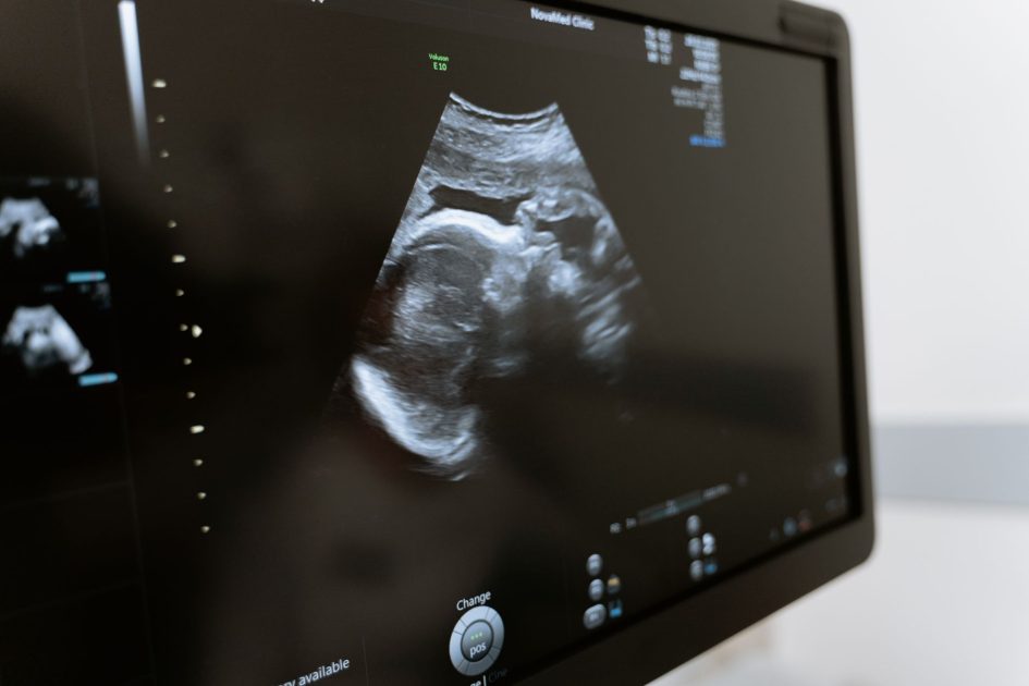 Usia 30 an Kini Banyak Kena Fatty Liver: 9 Panduan Lengkap 1 Close-up of an ultrasound showing a fetus on a monitor in a medical clinic.