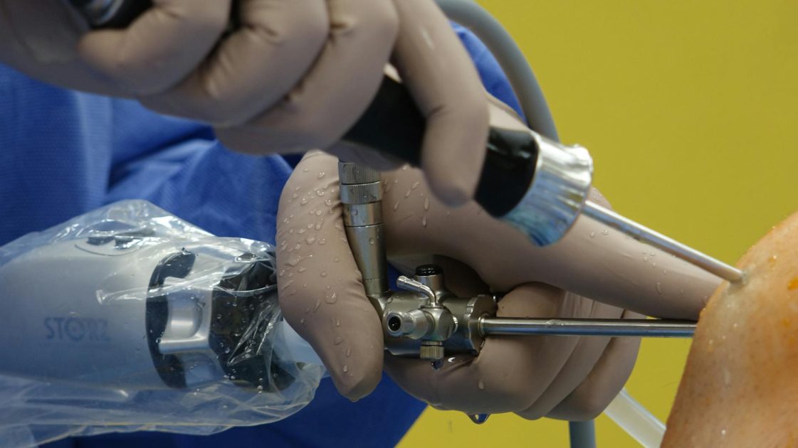 Video Endoskopi: Cara Kerja & 7 Penggunaan Penting 1 Detailed view of a surgeon performing arthroscopic knee surgery using specialized equipment.