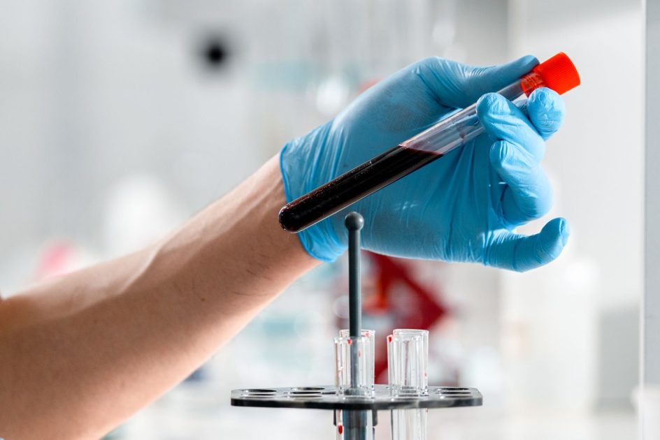 Anemia Bukan Cuma Soal Kesehatan: 7 Dampak Ekonomi & Performa 1 Close-up of a gloved hand holding a test tube with blood sample in a clinical research lab.