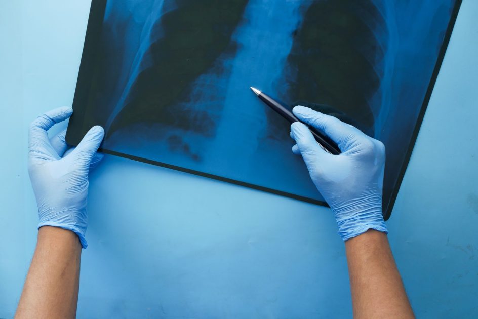 Awas! 7 Kebiasaan Picu Gagal Ginjal di Usia Muda 2024 1 A doctor in blue gloves examines a chest x-ray with a pen, focusing on medical diagnosis.
