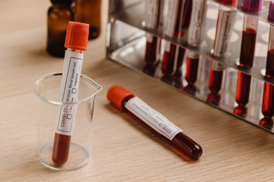 Diam-Diam Mengintai 7 Hal yang Merusak Ginjal & Solusinya 1 Close-up of blood sample tubes for Covid-19 testing in a laboratory setting.