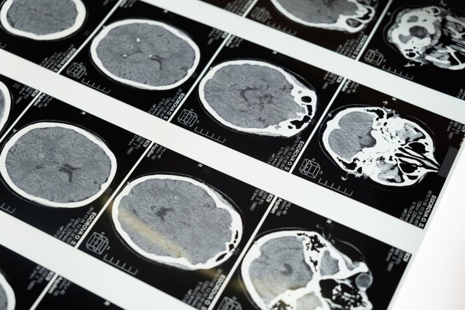 Terungkap Lewat Studi Kondisi Otak: 7 Dampak Buruk Menonton TV Berlebihan 1 Detailed brain MRI scans displayed on a lightbox, showcasing medical imaging techniques.
