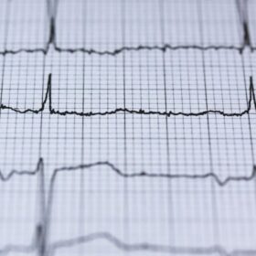 Bisakah Aritmia Dicegah? 7 Faktor Dokter Ungkap Lengkap