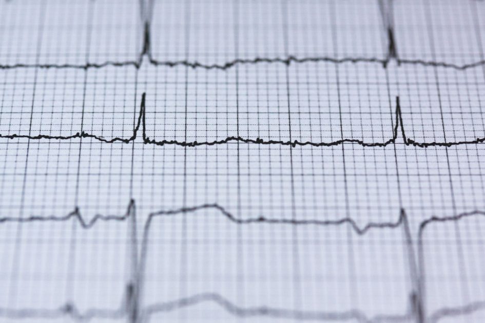 Bisakah Aritmia Dicegah? 7 Faktor Dokter Ungkap Lengkap 1 Close-up view of an ECG reading on graph paper, displaying heart rhythm and pulse data for medical analysis.