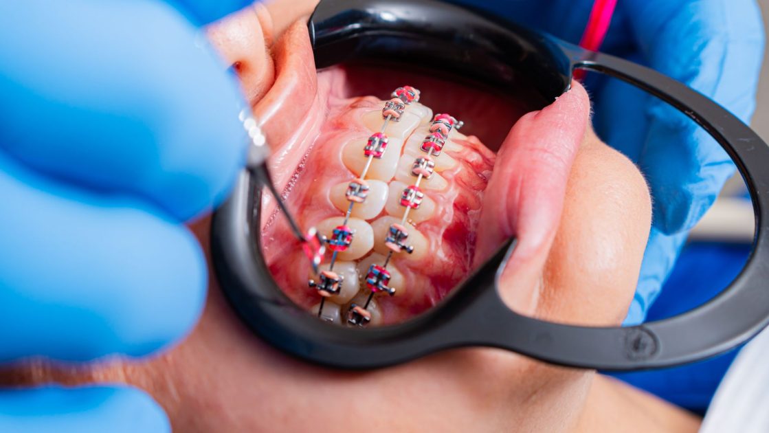 Kenapa Pemakai Behel Sering Iyup? 7 Penyebab & Solusi 1 Close-up of dental braces being examined by dentist using tools with gloves.