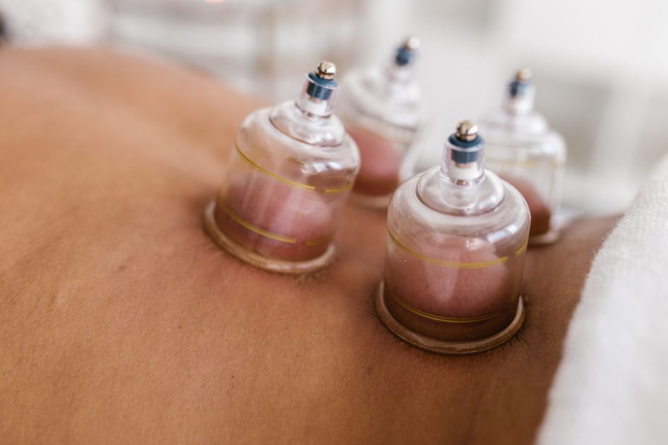 Andre Onana Jalani Terapi Bekam: 7 Manfaat & Panduan Lengkap 1 Detailed image of cupping therapy on a person's back, showcasing alternative medicine practice.