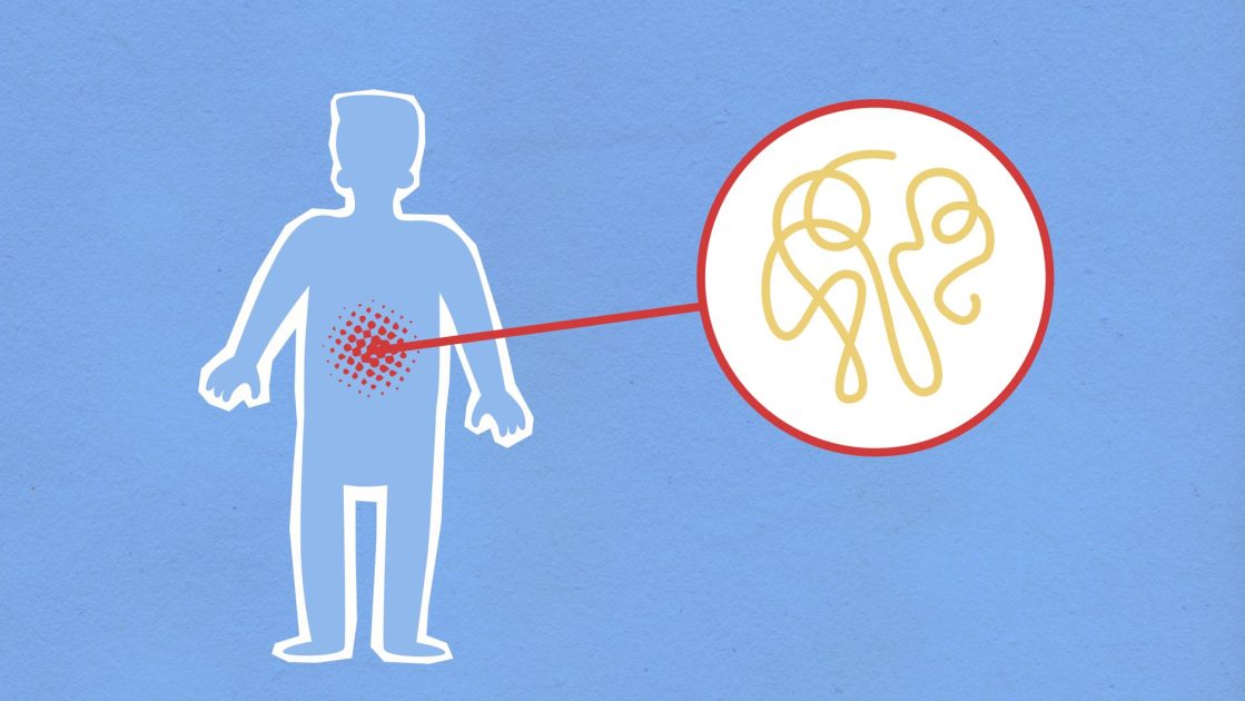Sering Menahan BAB Bikin Anak Kena Usus Buntu? 7 Fakta Penting 1 Cutout paper composition representing sick human figure with viral infection in stomach on blue background